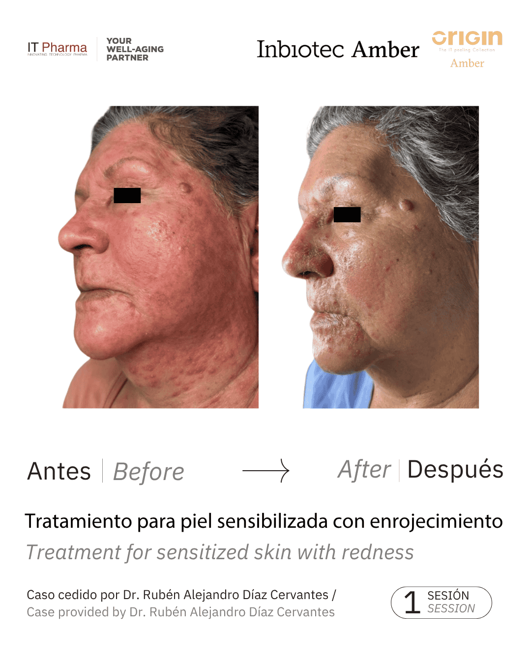 Tratamiento para piel sensibilizada con enrojecimiento